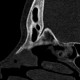 Fracture of nasal bones: CT - Computed tomography